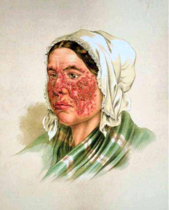 Young B. reccomend Facial blood accumulates lumps