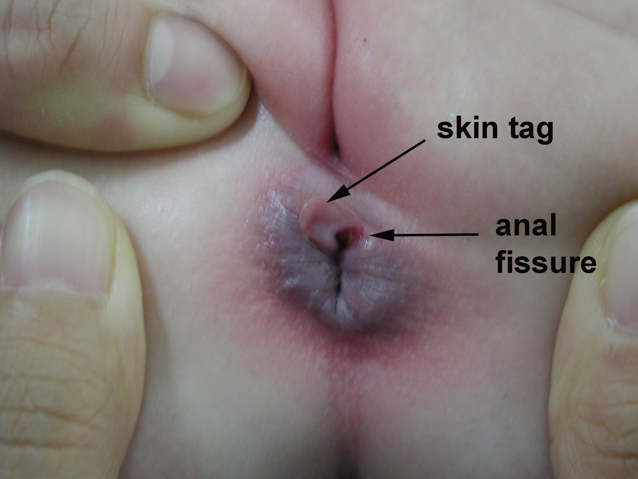 best of Tag anal skin wart vs Anal