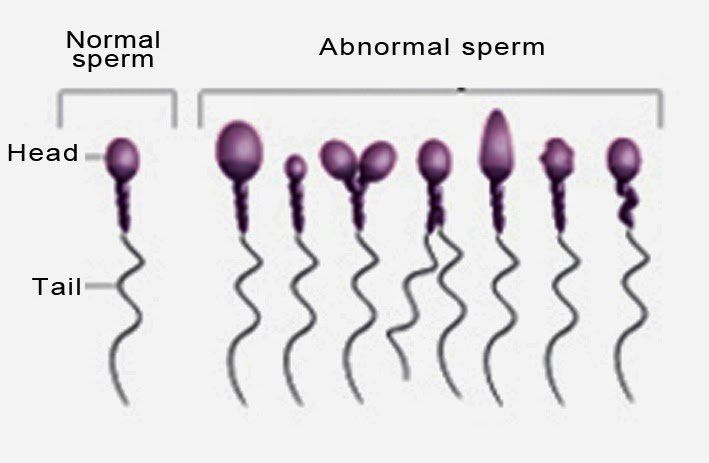 Turk reccomend Abnormal tails on sperm