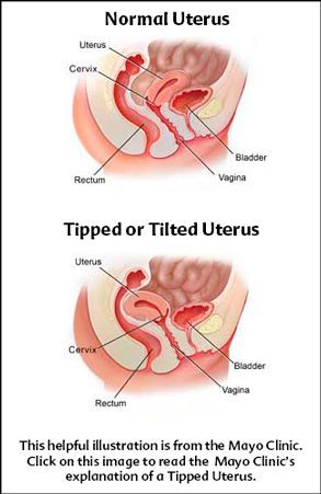 best of A uterus for retroverted position sex Best