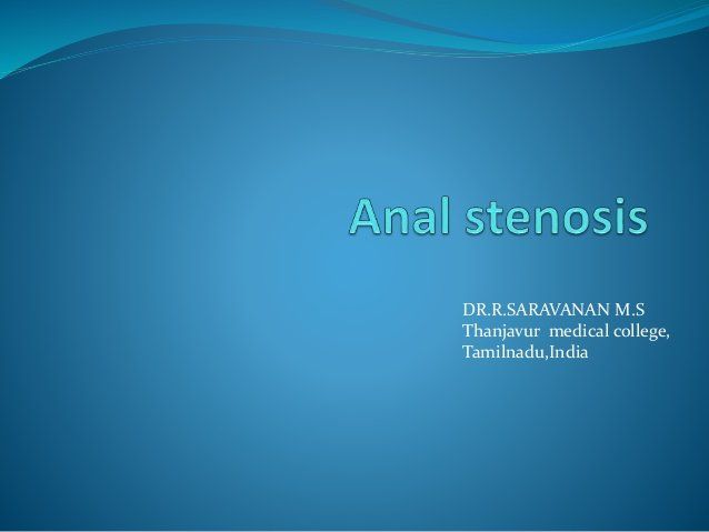 Any doctors who treat anal stenosis