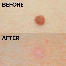best of Mole Home removal remedies on facial