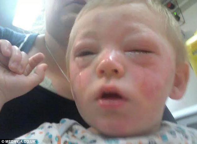 Hazy reccomend Infant severe facial rash anaphylaxis