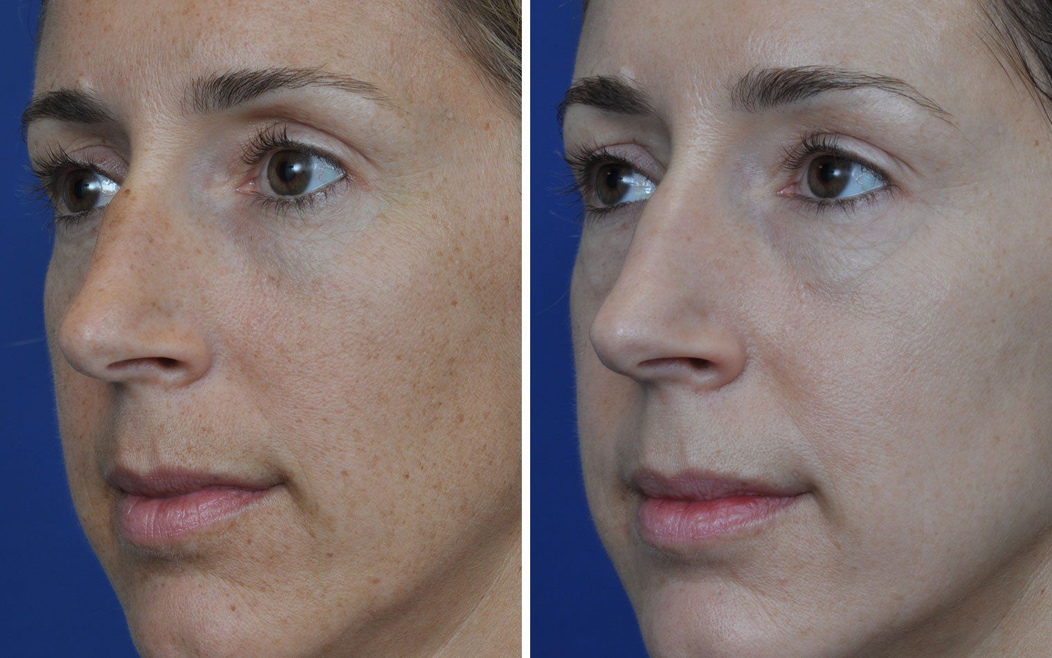 Red L. reccomend After before facial laser surgery