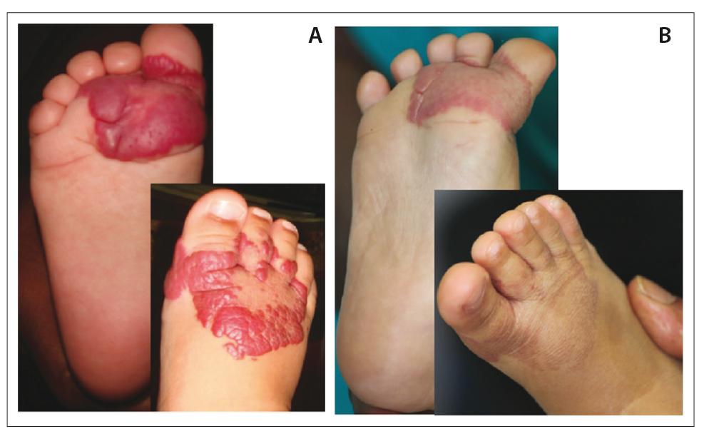 Chardonnay reccomend Adult hemangioma in the foot