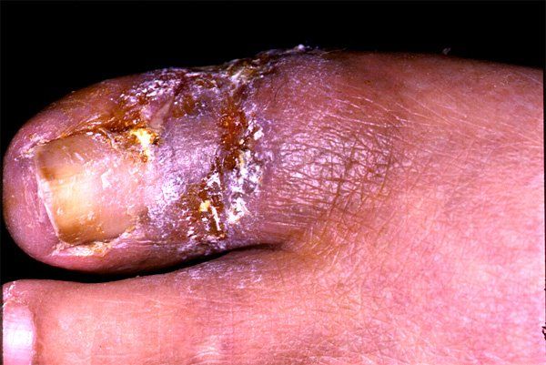 best of In the hemangioma foot Adult
