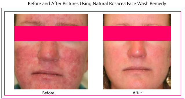best of Cleansers rosacea Facial for