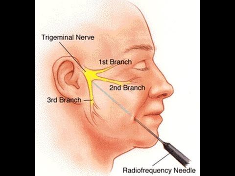best of Forehead Facial neuropathy