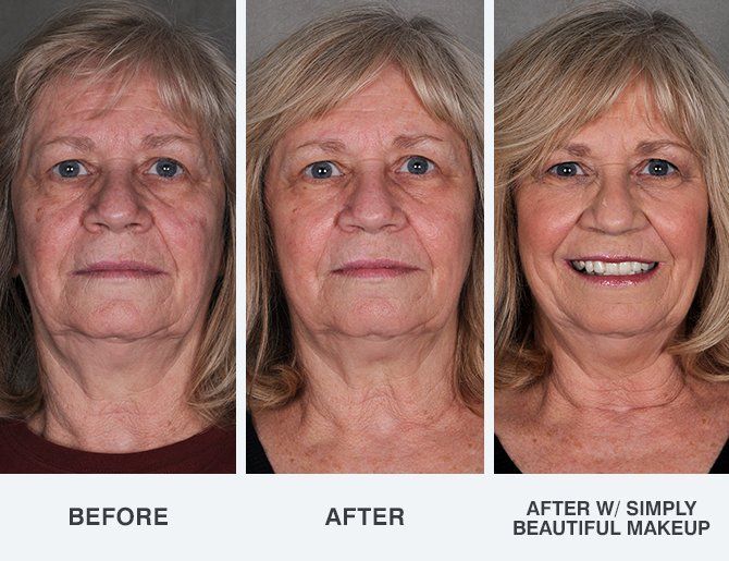 best of Before laser surgery facial After