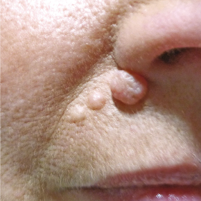 Punkin reccomend Facial lesions skin