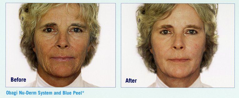 Facial peel system