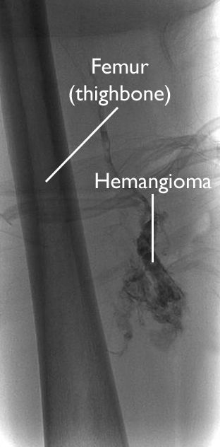 Adult hemangioma in the foot