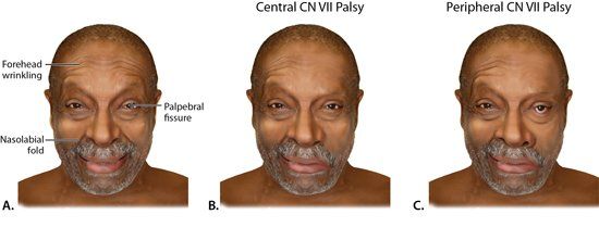 Snicker reccomend Facial neuropathy forehead
