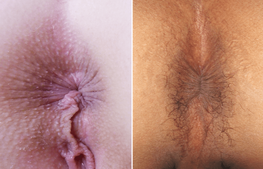 Anal bleaching before and after pics