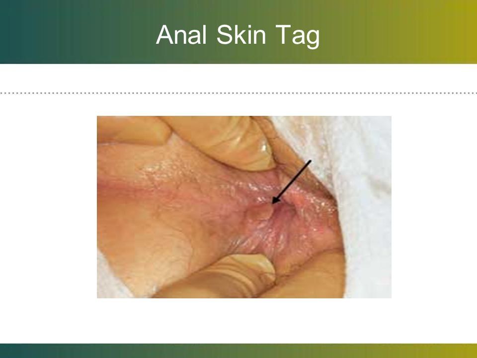 Anal skin tag vs anal wart