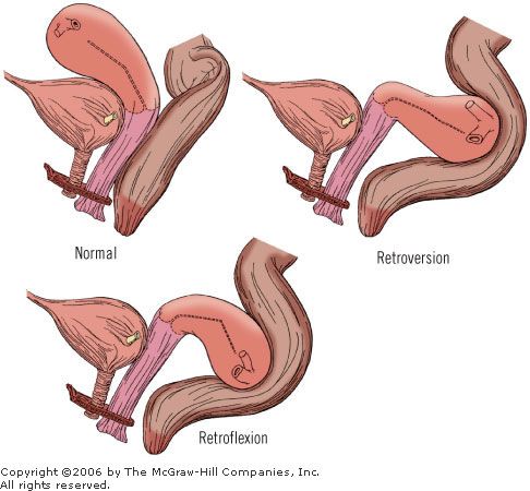 best of A uterus for retroverted position sex Best