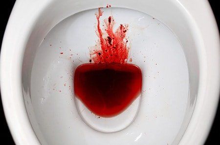 Waffle reccomend Anal bleeding is it serious