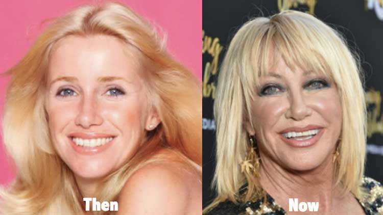 Suzanne somers facial