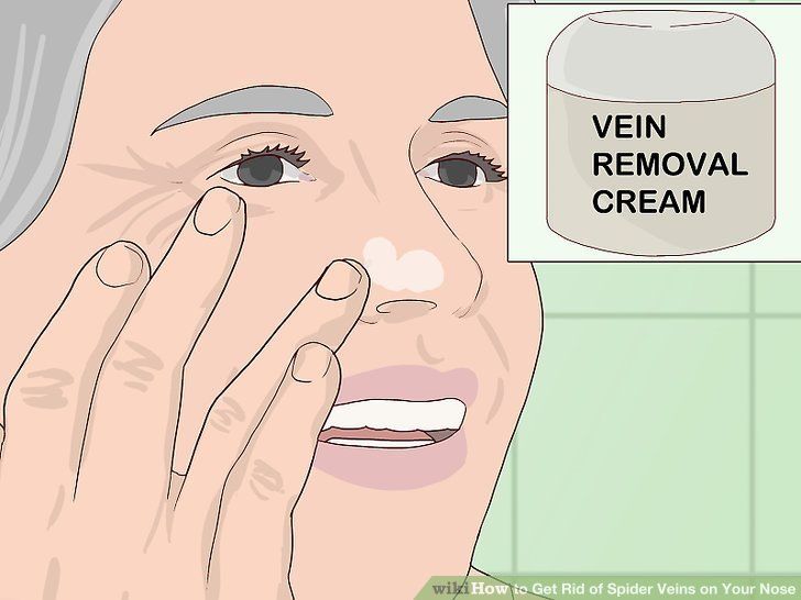 Get rid of facial spider veins