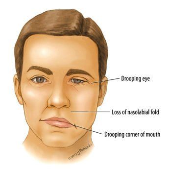 Renegade reccomend Facial nerve infection viral