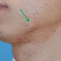 Cheese reccomend Facial skin cysts