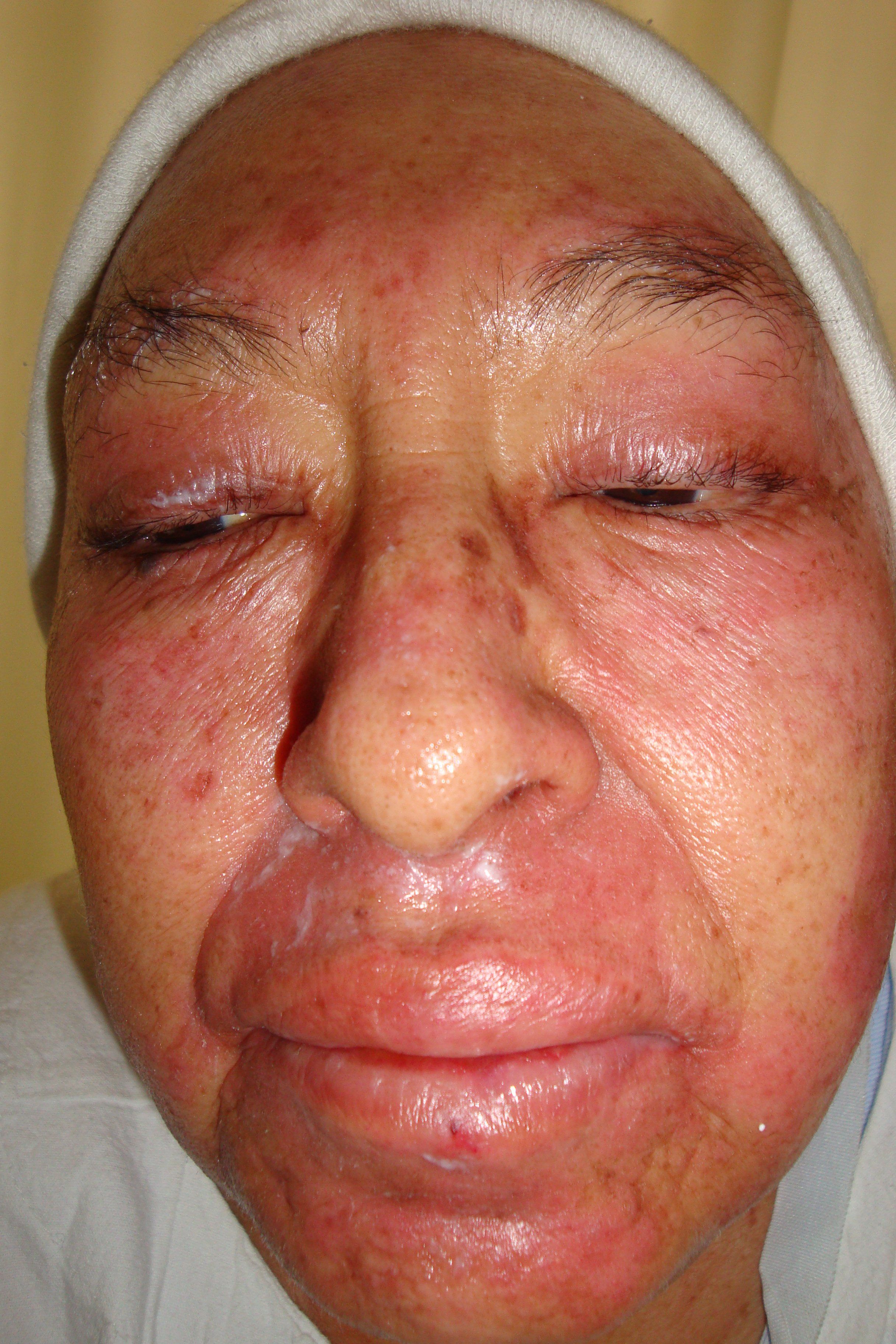 Winter reccomend Facial skin discoloration hepatitis c mrsa