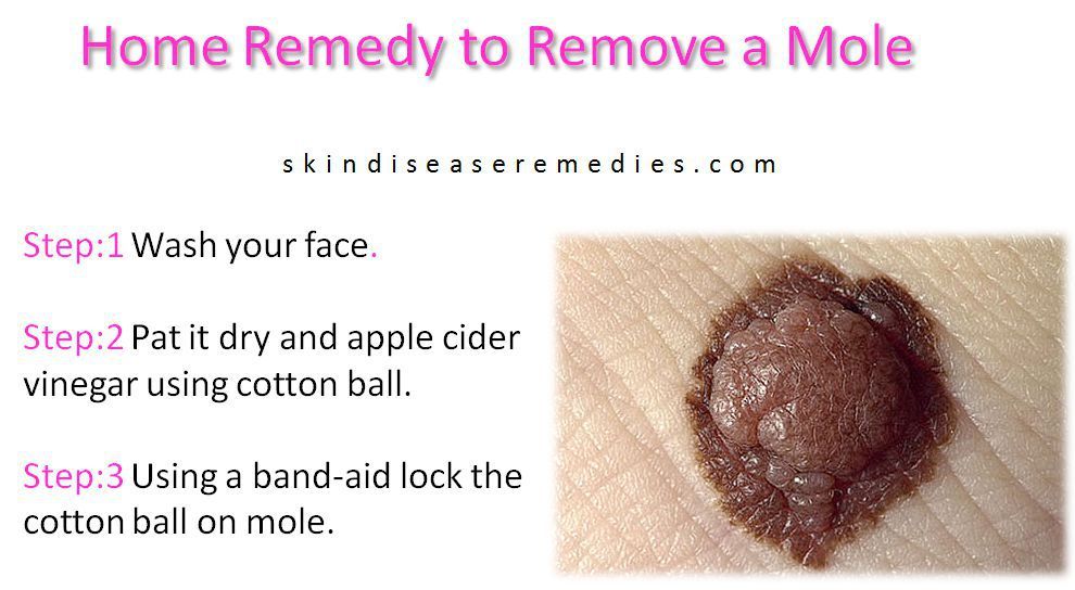 Dollface reccomend Home remedies on facial mole removal