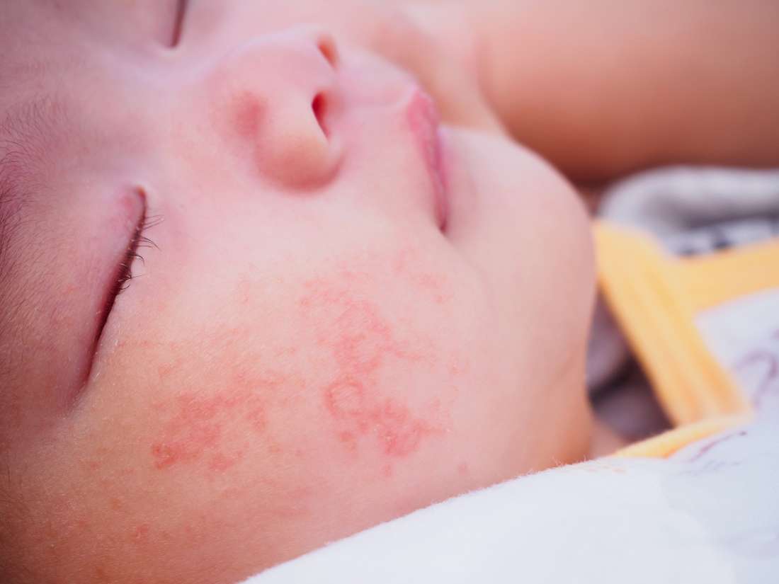 Rosebud reccomend Infant severe facial rash anaphylaxis