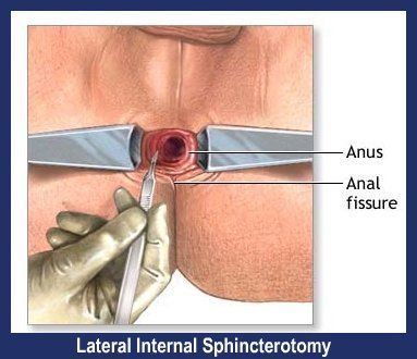 best of Fissure Lateral anal