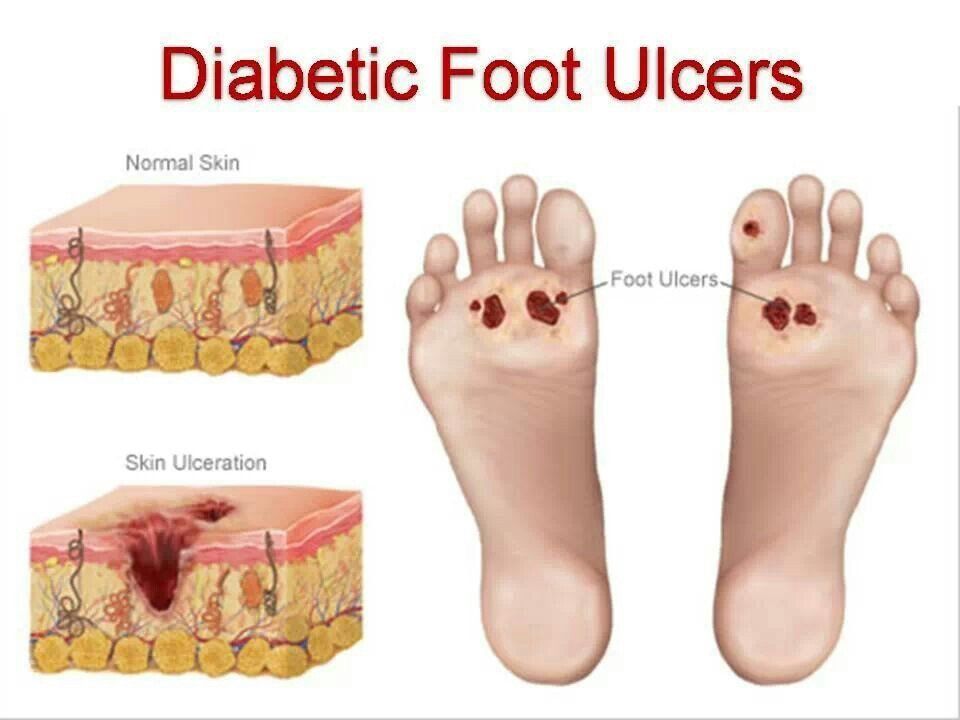 best of Bottom foot for Pad ulcer of